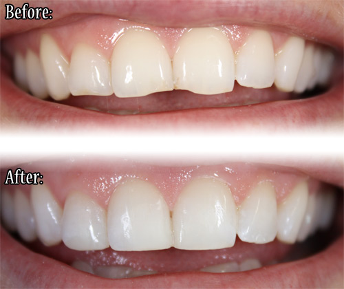 Composite veneer