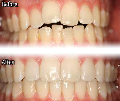 Invisalign results