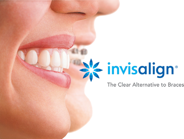 Invisalign is the clear alternative to braces.
