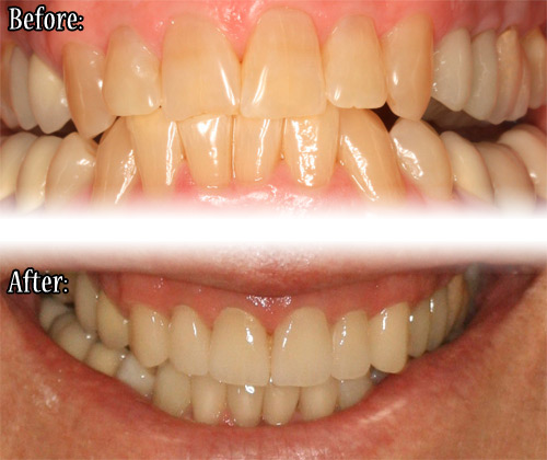 Porcelain veneer results